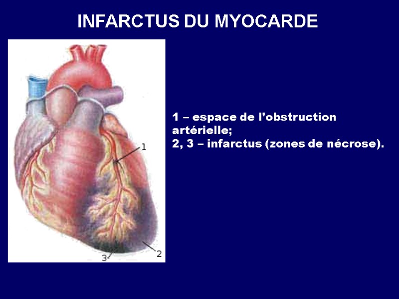 INFARCTUS DU MYOCARDE 1 – espace de l’obstruction artérielle; 2, 3 – infarctus (zones